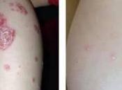 Before Afters Client Psoriasis Eczema Treatment