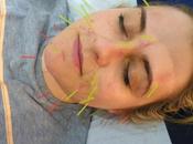 Acupuncture Facial Review