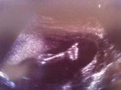 Baby’s Thumbs-up Saves from Being Aborted