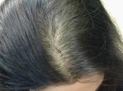 What Frontal Hair Loss? Causes Treatment Tips