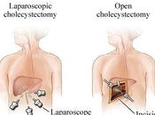 LAPAROSCOPIC OPEN Surgery