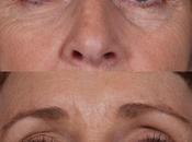 Beautiful Eyebrows from Brow Lifts Hair Transplants