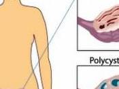 Dangerous PCOS Syndrome?