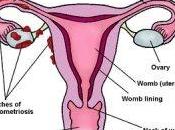Endometriosis Know Facts About