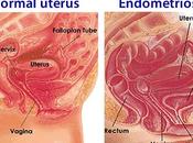 Endometriosis Herbal Treatment Lifestyle Changes
