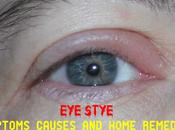 Symptoms Causes Home Remedies Stye