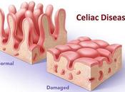 Your Mouth Could Warning That Have Celiac Disease