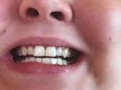 Discovered That Need Braces After Visiting Orthodontist