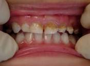 Early Indicators Tooth Decay