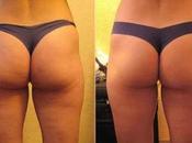 Here Apple Cider Vinegar Benefits Cellulite!