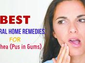 Best Natural Home Remedies Pyorrhea (Pus Gums)