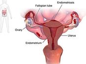 Ayurvedic Treatment Endometriosis