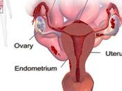 Endometriosis Ayurvedic Treatment Diet Avoid Surgery