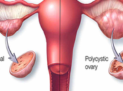 Alternative Treatment Pcos (Polycystic Ovarian Syndrome)