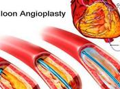 Angioplasty FAQs