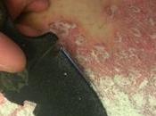 Treat Plaque Psoriasis Ayurveda-Home Remedies