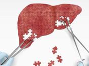 Fatty Liver Disease Fastest-growing Reason Transplants Young U.S. Adults
