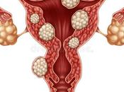 Foods Avoid Have Fibroids