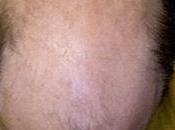 Football Hair Loss Cover-Ups