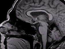Decoding Superficial Siderosis