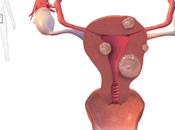 Fibroids: What Every Woman Should Know