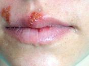 Prevent Herpes Transmission