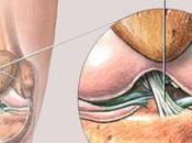 Ayurvedic Treatment Anterior Cruciate Ligament Injury