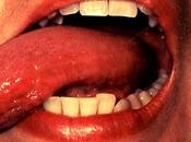 Through Oral Lead Mouth Cancer?