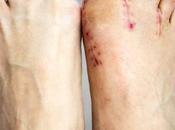 Weeks Post Bunion Surgery Update