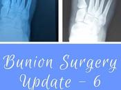 Bunion Surgery Update Weeks Post Operation