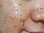 Keep Your Acne Pimples Bay: From Mugwort Mask Review