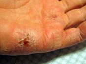 Best Natural Essential Oils Heal Eczema