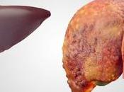 Ayurveda Treat Liver Cirrhosis with Diet Herbal Remedies