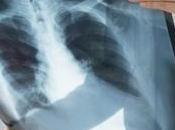 X-rays Scans Increase Risk Cancer?