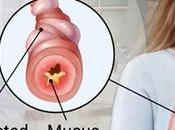 Asthma- Symptoms, Causes Treatment