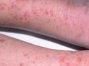 Meningitis Treated Naturally