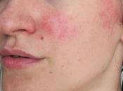 Need Know About Spots Redness Skin