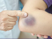 Everything Know About Bruise That Won’t Away