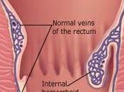 Hemorrhoids: Causes Symptoms Internal External Hemorrhoids