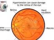 High Blood Pressure Effect Eyes (HBP, Hypertension) Causes, Symptom