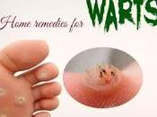 Homemade Wart Treatment