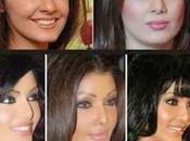 Bollywood Celebrities Look Before After Plastic Surgery, किन्होंने कराया प्लास्टिक सर्जरी