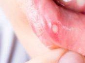 Mouth Ulcers