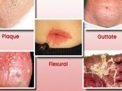 Safe Effective Treatment Psoriasis with Pranayama Ayurvedic Herbs