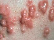 Treat Keloid Ayurveda?