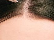 Mesotherapy Effective Hair Loss?