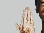 Remedies Skin Discoloration Pigmentation