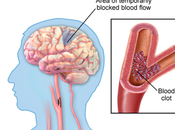 Manage (Transient Ischemic Attack) With Ayurveda?