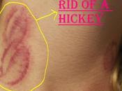 Hickey What