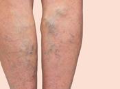Varicose Veins More Than Just Cosmetic Issue